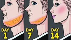 the stages of acne on woman's face in four different stages, including one day and seven days