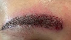 Dallas Ethnic Hispanic Eyebrow Hair Transplant Closeup Right After Hair Transplant Surgery, Botox Fillers