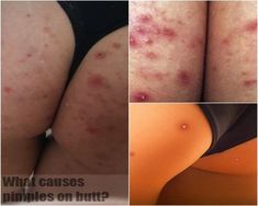 Generated Description with relevant hashtags. Body Pimples Remedies, How To Get Rid Of Inner Thigh Pimples, How To Get Rid Of Dark Spots On Buttocks, How To Get Rid Of Pimples On Buttocks, How To Get Rid Of Buttocks Acne Quick, How To Get Rid Of Bumps On Buttocks, How To Shave Buttocks, How To Get Rid Of Buttocks Acne At Home, Clear Buttocks Skin Care