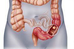 Large Bowel, Medical Words, Today Tips, Colon Health, Skin Natural Remedies, Types Of Cancers, Health Remedies, Eating Well, Health Tips