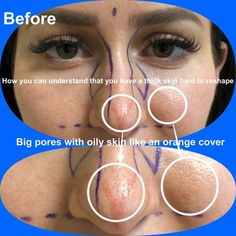 Bulbous Tip Rhinoplasty, Tip Rhinoplasty, Nose Plastic Surgery, Nose Surgery Rhinoplasty, Nose Fillers, Crooked Nose, Rhinoplasty Nose Jobs, Big Pores