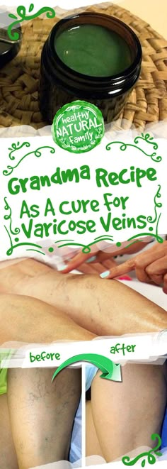 Grandma Recipe As A Cure For Varicose Veins – Toned Cheezburger Funny, Home Remedies For Spiders, Varicose Vein Remedy, Instagram Jokes, Grandmas Recipes, Diy Health, Natural Home Remedies, Natural Medicine, Memes Funny