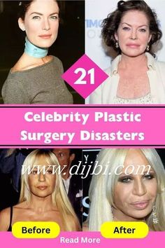 Bad Celebrity Plastic Surgery, Botched Plastic Surgery, Cheek Implants, Bad Plastic Surgeries, Plastic Surgery Fail, Botox Lips, Plastic Surgery Gone Wrong, Celebrity Plastic Surgery, Nose Job