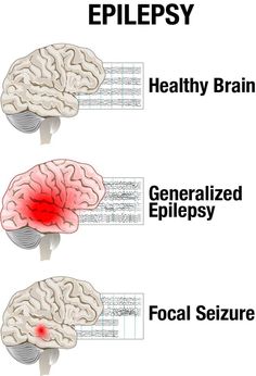 Types Of Seizures, Seizures Awareness, Brain Activities, Koh Tao