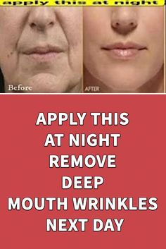 Wrinkles Remedies Face, Mouth Wrinkles, Wrinkle Remedies, Skin Tightening Face, Wrinkle Free Skin, Lip Wrinkles, Deep Lines