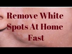 Remove Skin Tags Naturally, Blind Pimple, Pimples Under The Skin