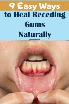 Tooth Scaling, Supplements For Hair Growth, Grow Back Receding Gums, Supplements For Skin, Fix Teeth, Good Vitamins For Women, Take Supplements