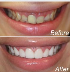 Gummy Smile Correction, Dentist Aesthetic, Teeth Makeover, Dental Makeover, Snap On Smile, Zoe Hart, Veneers Teeth, Beautiful Teeth, Dental Design