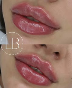 1ml Lip Filler, Stunning Makeup Looks, Earthy Vibes, Facial Aesthetics, Lip Filler