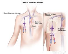 Subclavian Vein, Central Venous Catheter, Intravenous Fluids, Nursing School Essential, Nurse Study Notes, Oncology Nursing, Acute Care, Medical School Essentials