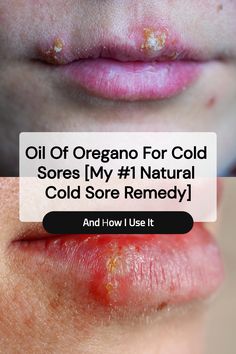 Save this pin to learn how I use oil of oregano for cold sores. If you’re looking for a natural cold sore remedy that packs a punch, this might become one of your favorites, too. Pepermint Oil, Natural Medicine Cabinet