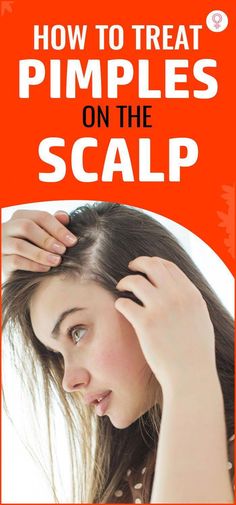 Have you ever felt a painful bump on your scalp? Pimples on scalp can be quite uncomfortable. But you sure can treat them and even prevent their recurrence Head Acne Remedies, Scalp Pimples, How To Treat Pimples