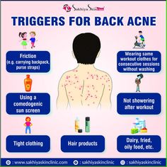 Back acne is a troublesome condition that often leaves behind ugly brown-black blemishes. Back acne is usually caused by excess oil and dead skin cells that build up over time. It can also be caused by your daily habits. So, here are some causes of back acne that you should look out for. __ #sakhiyaskinclinic #skinclinic #dermatologist #backacne #acne #breakouts #clearcell #healthyskin #glowingskin #relaxing #skintreatments #asthethic #beauty #acnetreatment #acnescarsremoval Back Acne Causes, Back Acne, Bad Acne, Morning Skincare, Acne Scar Removal, Morning Skin Care Routine