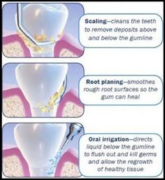 Dentaltown - Scaling and root planing, non-surgical periodontal therapy, or deep cleaning, is the process of removing dental plaque and calculus from beneath the gums which causes inflammation. Dental Hygienist Humor, Dental Information