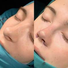 Ethnic Rhinoplasty, Bulbous Nose, Face Surgery, Rhinoplasty Before And After, Job Inspiration, Pretty Nose