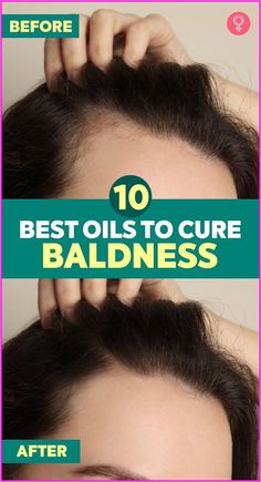 Bonus: Use a shower filter to remove chlorine and other chemicals from your water. #hairgrowthresults #hair #hairfall How To Grow Hair Back In Bald Spot, Hair Growth For Bald Spots, How To Grow Hair In Bald Spots, How To Get Rid Of Bald Spots For Women, Expensive Hair, Hair 101, Aging Hair, Receding Hairline, Hair Growing