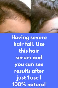 Having severe hair fall. Use this hair serum and you can see results after just 1 use | 100% natural Hair fall is one of the most common problem. Up to 100 hair loss is a normal thing but if you are losing more, it is considered as severe hair fall. Hair fall can be because of many different reasons abut if you take corrective action at right time, you can avoid it successfully at … Natural Hair Fall, Thick Hair Remedies, Hair Growing, Hair Diy, Hair Masks, Hair Growth Serum, Hair Treatments, Thicker Hair, Lost Hair