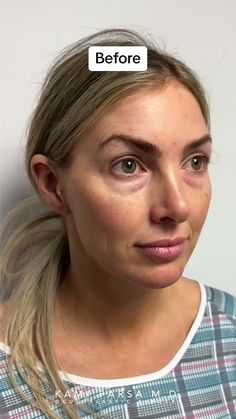 Treatment for Eye Bags that Concealer Won't Cover | Dr. Kami Parsa, M.D.