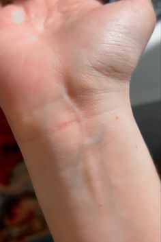 a person's hand with white spots on it