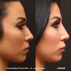 Nose Job Filler, Liquid Nose Job, Liquid Rhinoplasty, Jawline Filler, Nose Ideas, Cosmetic Nurse, Restylane Lyft