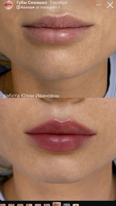 Korean Cherry Lips Filler, Types Of Lip Filler Shapes, Asian Lip Filler, Lip Shapes Filler, Round Lip Filler, Lip Filler On Small Lips, Lip Fillers Shapes, Keyhole Lips