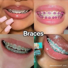 Aesthetic Braces Color, Brace Colors, Purple Braces, Pink Braces, Red Braces