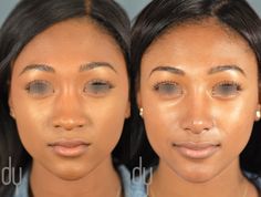 Nose Plastic Surgery, Ethnic Rhinoplasty, Rhinoplasty Nose Jobs, Rhinoplasty Before And After, Rhinoplasty Surgery, Facial Surgery, American Female, Perfect Nose, Best Lip Gloss