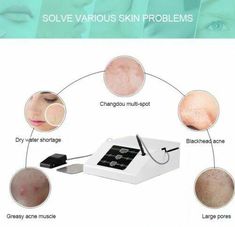 Especially for recurrent acne. Acne lives in sebaceous gland and eats oil produced in the organ. Using insulated RF needle, Acacia can destroy sebaceous gland without causing any burn on skin. - Acne (acne, pimples, suppuration, nodules, cysts). Blackheads On Nose, Acne Removal, Natural Acne Remedies, Get Rid Of Blackheads, Scar Removal, Acne Remedies, Remove Acne, Shrink Pores