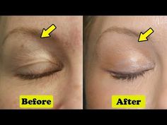 Drooping Eyelids, Droopy Eyelids, Droopy Eyes, Face Yoga Facial Exercises, Erase Wrinkles, Facial Yoga, Eye Exercises, Face Exercises