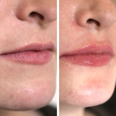 Lip Inspiration, Juvederm Lips, Aesthetics Clinic, Beauty Treatments Skin Care