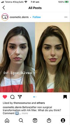 Dimpleplasty Before And After, Liplift Surgery Before And After, Nose Tip Filler, Chin Fillers Before After Round Face, Face Contouring Fillers, Armonizacion Facial, Facial Contouring Surgery, Plastic Surgery Fails, Filler Face