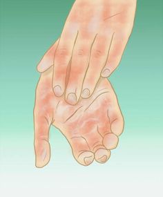 Are your hands, feet, and/or legs red and blotchy? I was shocked when my doctor told me I have poor circulation. This is what I've learned about how to treat this condition.