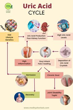 gout attack and high uric acid in gouty arthritis Uric Acid Remedy, Joints Pain Remedy, Kidney Pain, Allergy Remedies