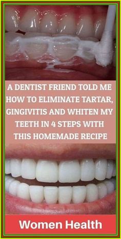 A DENTIST FRIEND TOLD ME HOW TO ELIMINATE TARTAR Teeth Health, Natural Healing Remedies, Oral Health Care, Teeth Care, Natural Health Remedies, White Teeth, Tooth Decay, Healthy Teeth