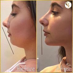 Chin Surgery Before And After, Chin And Lip Filler, Chin Augmentation Before And After, Chin Implant Woman, Chin Fillers Before After Round Face, Cheek Filler Before And After, Chin Implant Before And After, Cheekbone Filler, Chin Lipo Before And After