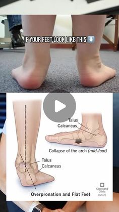 PhysioMax_Care on Instagram: "Credits- @dr.jenny.pt 

The movement and stability of our arch is influenced and controlled by our intrinsic and extrinsic foot muscles.

The intrinsic muscles of the foot are very under appreciated structures - mainly being our toe flexors and abductors/adductors.

Extrinsic muscles are your main muscles in your calf, muscles that allow your ankles to move side to side.

The importance of intrinsic foot strength is very underrated, as the foot is the first thing to touch the floor when we walk - if that’s dysfunctional, it goes up the kinetic chain.

•The intrinsic muscles are much stronger than we realized - research is very behind on studies looking at intrinsic foot strength as it relates back to function.

•They contribute significantly to our ability to