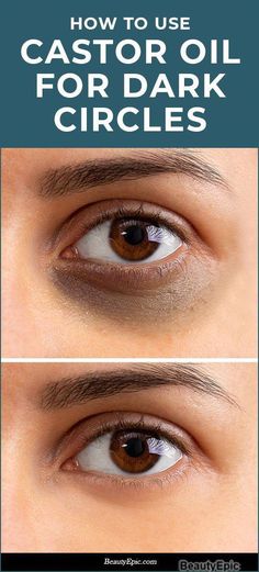 Reduce Eye Bags, Dark Circles Around Eyes, Dark Circle Remedies, Dark Eye Circles, Eye Cream For Dark Circles, Remove Dark Circles, Skin Care Wrinkles, Dark Circles Under Eyes, Dark Under Eye