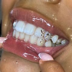 a close up of a person with braces on their teeth and diamond studs