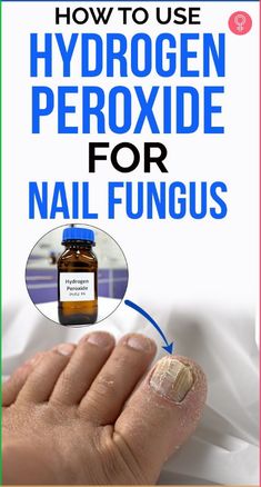 How To Use Hydrogen Peroxide For Nail Fungus: Oxidative therapy is one of the common home remedies available to manage this condition. This article discusses how hydrogen peroxide helps you treat nail fungus and how to use it. Keep reading to know more about it! #nailfungus #remedies #homeremedies Acne Free, Nail Fungus, Hydrogen Peroxide, Clear Skin, Being Used