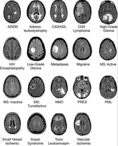 the different areas of the brain are labeled in black and white, including mris