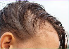 Hair loss on one side of head female could have several possible causes. Finding and preventing the underlying problem gives you the best way to regrow your hair. Hair Fall Reasons, Head Female, Hair Plugs, Fue Hair Transplant, Stimulate Hair Follicles, Female Hair, Hair Solutions, Hair Restoration