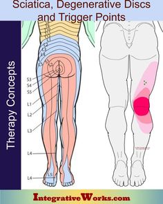 Sciatica, Degenerative Discs and Trigger Points - Integrative Works Intervertebral Disc, Forward Head Posture, Bulging Disc, Nerve Pain Relief, Sciatica Pain, Sciatic Nerve, Trigger Points, Hip Pain