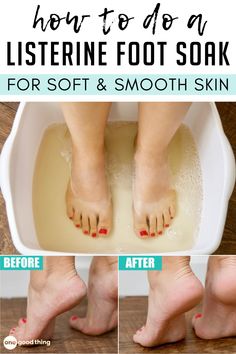 Listerine Foot Soak, For Soft Skin, Soft Smooth Skin, Pedicure At Home, Foot Soak, Toenail Fungus, Beauty Remedies, Skin Care Recipes, Beauty Recipe