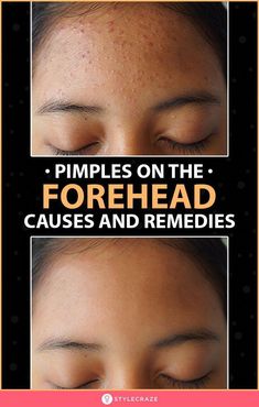 Forehead acne is a condition that affects many men and women worldwide. Learn about its causes, treatment options, and how to prevent it from coming back. Forehead Acne Cause, Hard Pimple, Forehead Bumps, Pimple Solution, Pimples On Forehead, Pimple Free Skin, Blind Pimple