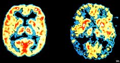 A curious result hints at the possibility dementia is caused by fungal infection. Memory Test, Pet Scan, Brain Activity, Brain Boost, Boost Memory, Body Cells, Genetic Testing, Healthy Brain