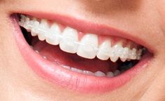 Happy Dental, Teeth Whitening Procedure, Invisible Braces, Health Aesthetic