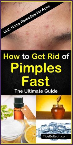 DO YOU DROOL WHEN YOU SLEEP YOU AR by lisa King | This newsletter was created with Smore, an online tool for creating beautiful newsletters for educators, nonprofits, businesses and more Home Remedies For Pimples, Get Rid Of Pimples, Blind Pimple, Rid Of Pimples, Pimples Under The Skin, Pimples Overnight, Home Remedies For Acne, How To Get Rid Of Pimples