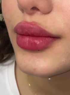 Lip Asthetic Picture, Heart Lip Filler, Types Of Lip Filler Shapes, Lip Filler 2ml, Lips Vision Board, Lip Injections Aesthetic, Juvederm Before And After Lips, Plump Lips Aesthetic, Lip Filler Aesthetic