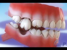 Dental Cavities, Tooth Replacement, Missing Teeth