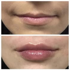 1ml Lip Filler, Fake Lips, Lip Augmentation